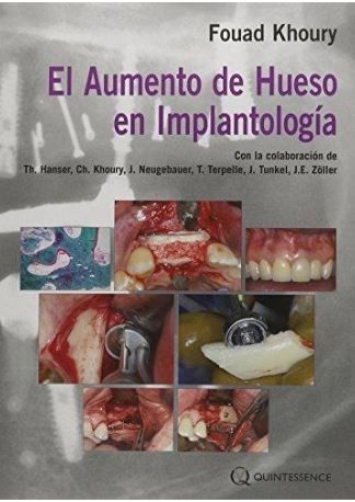 El Aumento de hueso en Implantología
